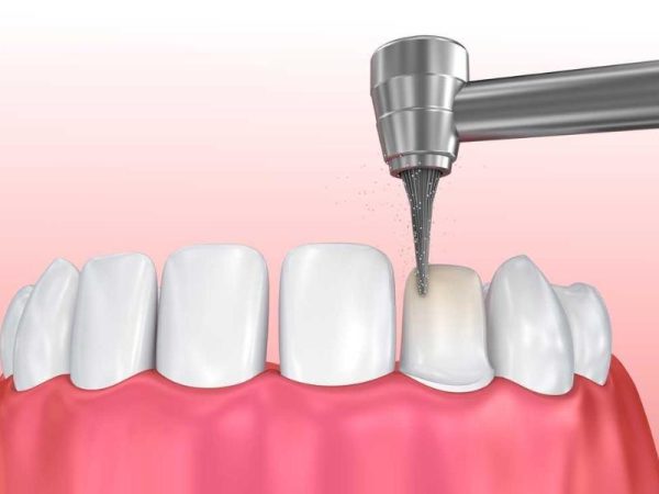 Mài răng sai tỉ lệ là nguyên nhân phổ biến khiến răng bọc sứ đau nhức