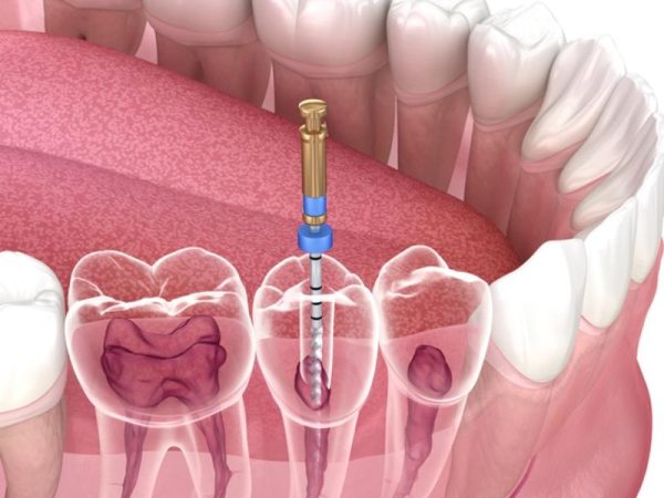 Bác sĩ sẽ cần phải thực hiện điều trị lại tủy nếu răng sứ bị đau nhức vì bệnh lý chưa điều trị dứt điểm