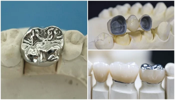 Răng sứ Crom Cobalt là sự cân bằng giữa độ bền, chi phí và yếu tố thẩm mỹ