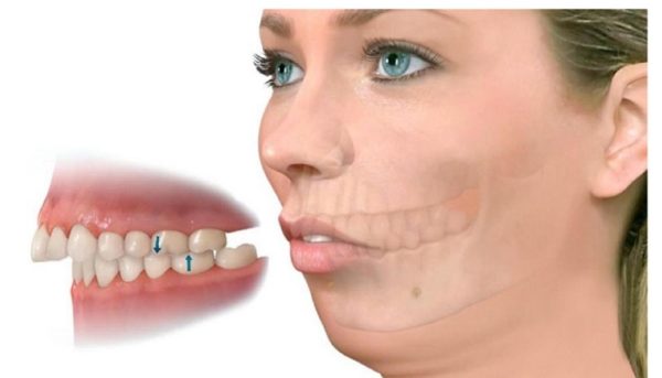 Tuỳ tình trạng hàm hô mà khách hàng được chỉ định phẫu thuật hay không