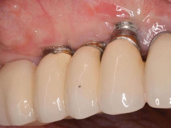 There are still cases where the patient’s body rejects the implant post