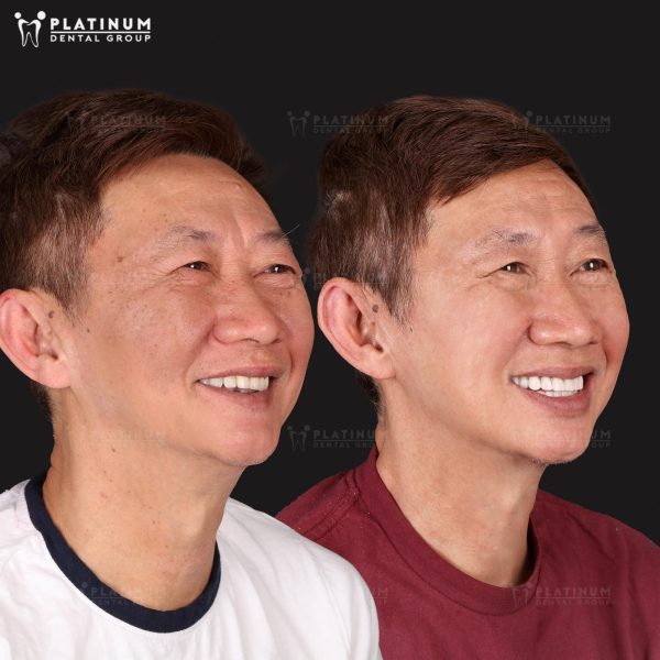 Caring for and maintaining proper oral hygiene is crucial for the success of implant integration