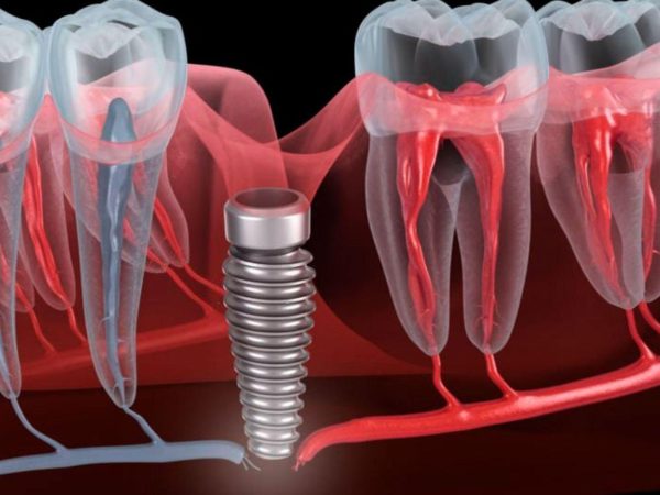 One of the potential side effects of dental implants is nerve damage
