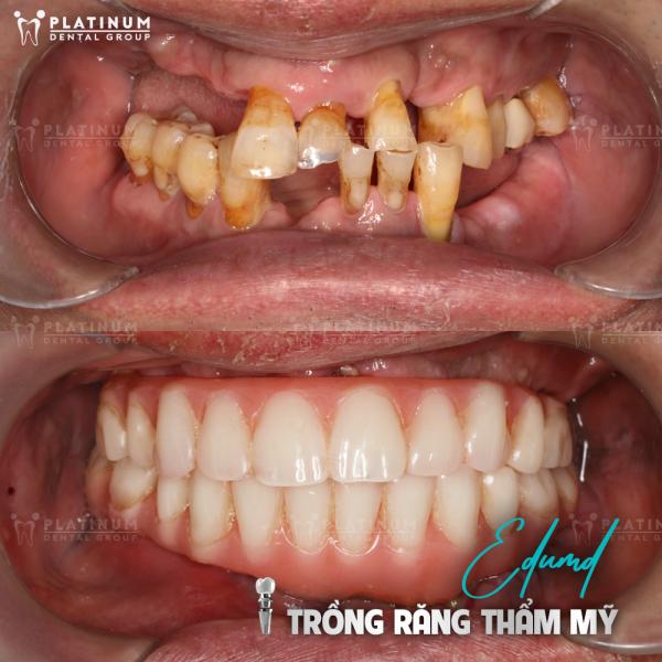 Gắn abutment và mão sứ, hoàn thiện phục hồi răng đã mất