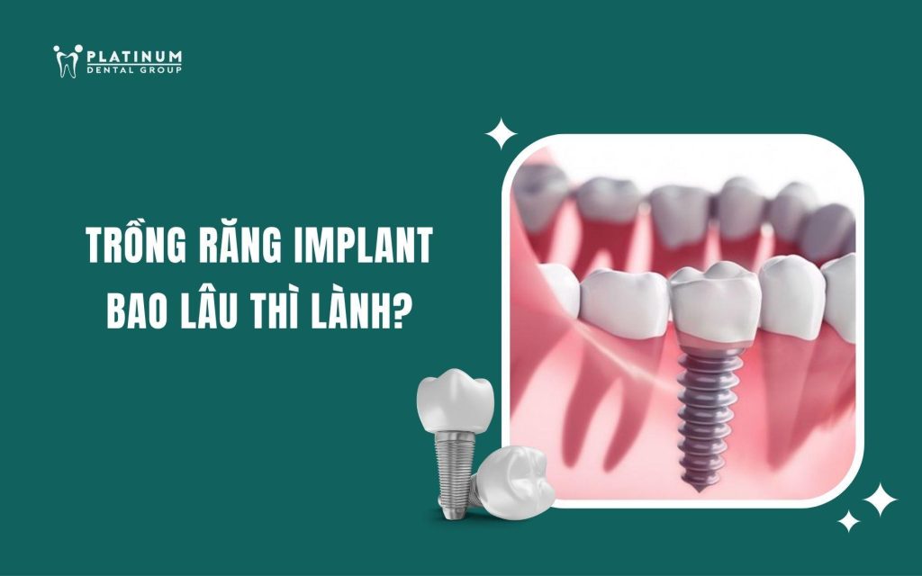 trồng răng implant bao lâu thì lành