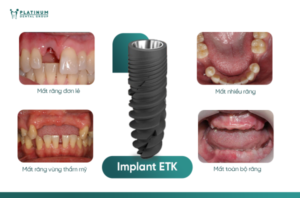 Loại trụ Implant và công nghệ thực hiện ảnh hưởng trực tiếp đến tốc độ lành thương