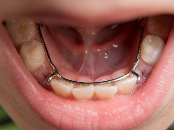 Trồng răng Implant cho trẻ em: Có nên hay không và những điều cần biết 3 Hàm giữ khoảng là khí cụ chỉnh nha được sử dụng phổ biến cho trẻ mất răng sữa sớm