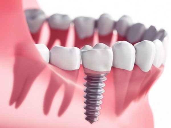 Trồng răng Implant cho trẻ em: Có nên hay không và những điều cần biết 9 Việc trồng răng Implant ở người trẻ tuổi mang lại nhiều lợi ích vượt trội