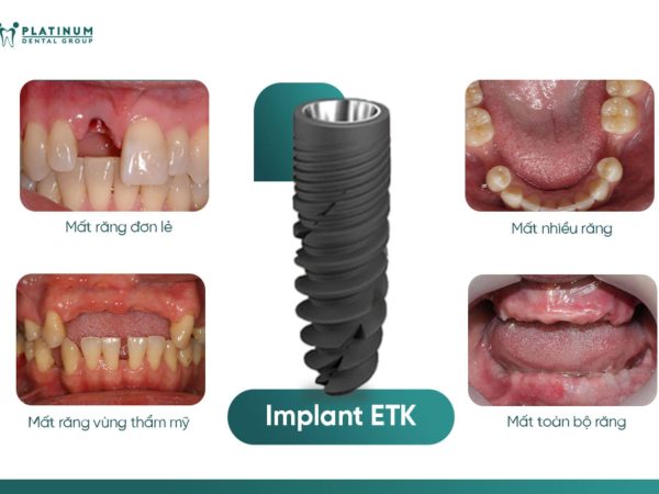 Trồng răng Implant cho trẻ em: Có nên hay không và những điều cần biết 13 Trụ Implant chính hãng từ các thương hiệu đạt chuẩn quốc tế
