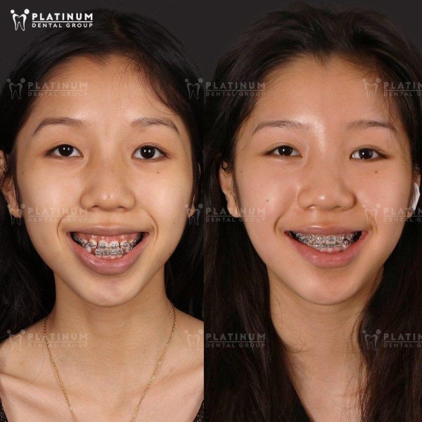 Trồng răng Implant cho trẻ em: Có nên hay không và những điều cần biết 4 Niềng răng là giải pháp giúp điều chỉnh vị trí răng, giúp sắp xếp nụ cười cân đối và giữ khoảng trống hợp lý cho Implant sau này