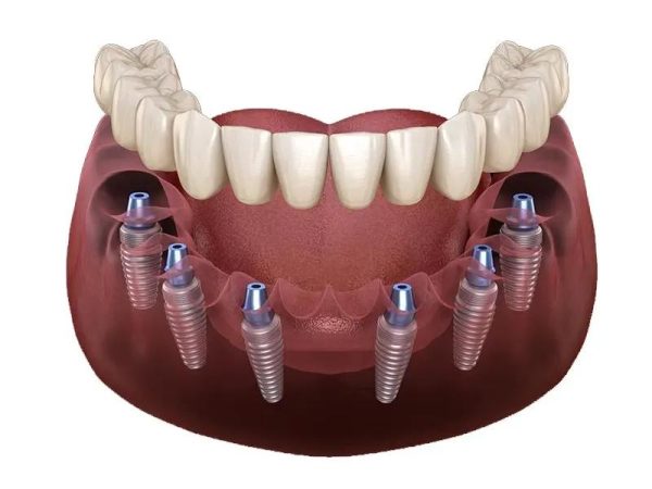 Trồng răng Implant Hàn Quốc giá bao nhiêu? Cập nhật bảng giá mới nhất 3 Số lượng răng trồng ảnh hưởng đến chi phí trồng răng Implant Hàn Quốc