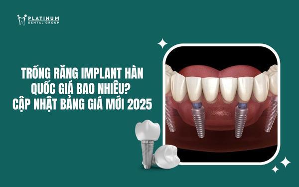 trồng răng implant hàn quốc giá bao nhiêu