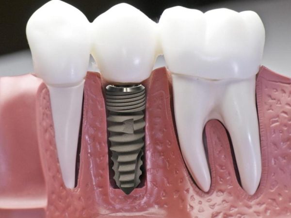 Trồng răng Implant Hàn Quốc giá bao nhiêu? Cập nhật bảng giá mới nhất 1 Chi phí trồng răng Implant dòng DIO UV đơn lẻ – giá từ 18 đến 25 triệu đồng/răng