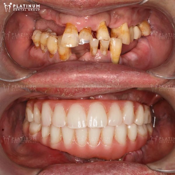 Trồng răng sứ cố định giúp thay thế một hoặc nhiều răng mất