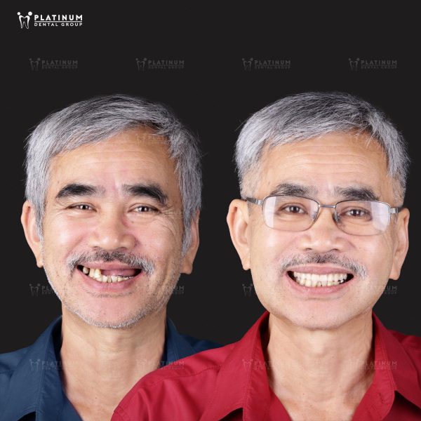 Khách hàng trồng răng sứ cố định bằng cách cấy ghép Implant toàn hàm