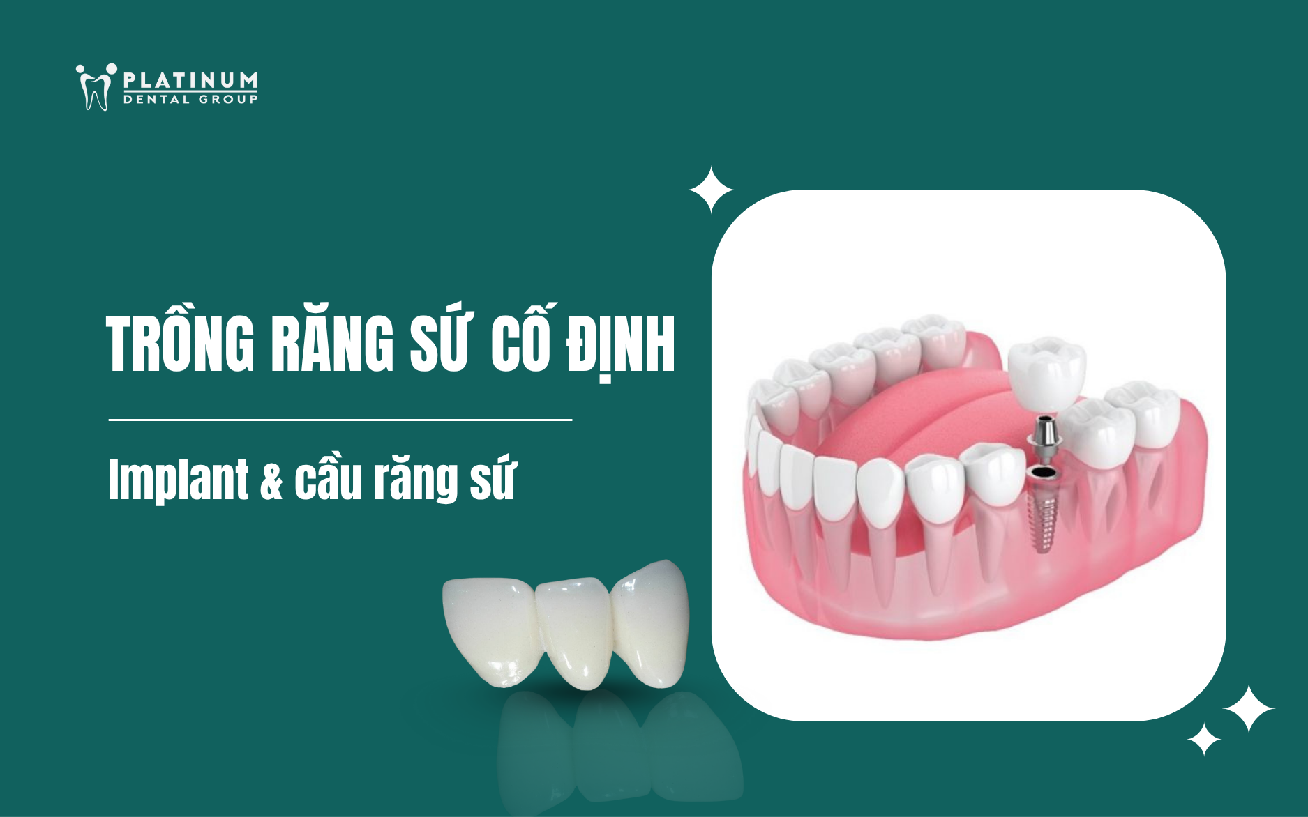 trồng răng sứ cố định