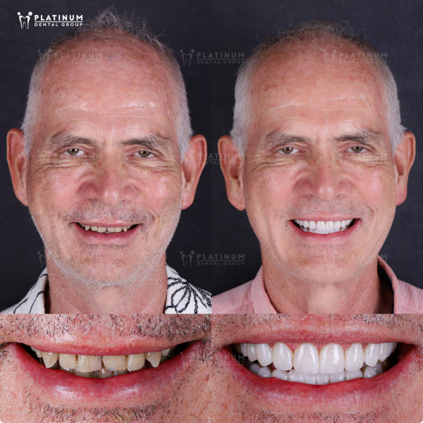 Mr. Michael Osswald transformed with a bright white smile after restoring 15 teeth with porcelain Veneers