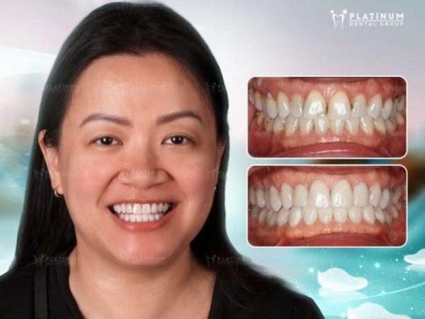 Ms. T.V. glowing with her new smile, no longer having dark spots around the gumline thanks to Lisi porcelain Veneers