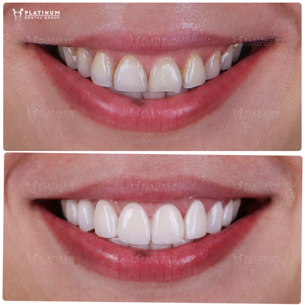 The result after getting Veneers is a more perfect version while still maintaining a natural look