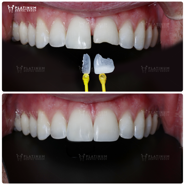 Porcelain veneer - a comprehensive restoration solution that helps close gaps between teeth, making them whiter and stronger every day