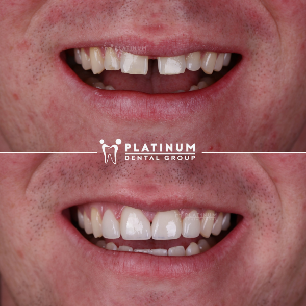 A case of safe and effective porcelain crowns for spaced teeth at Platinum Dental Group