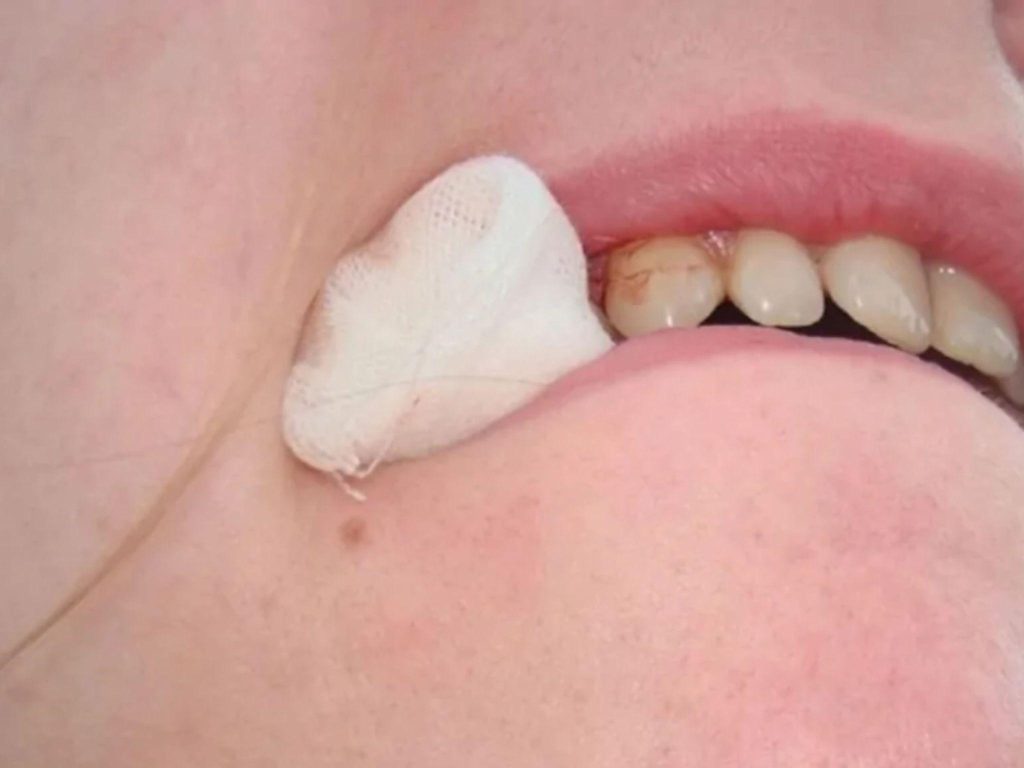 Cắn chặt bông gòn để cầm máu sau khi cắm Implant