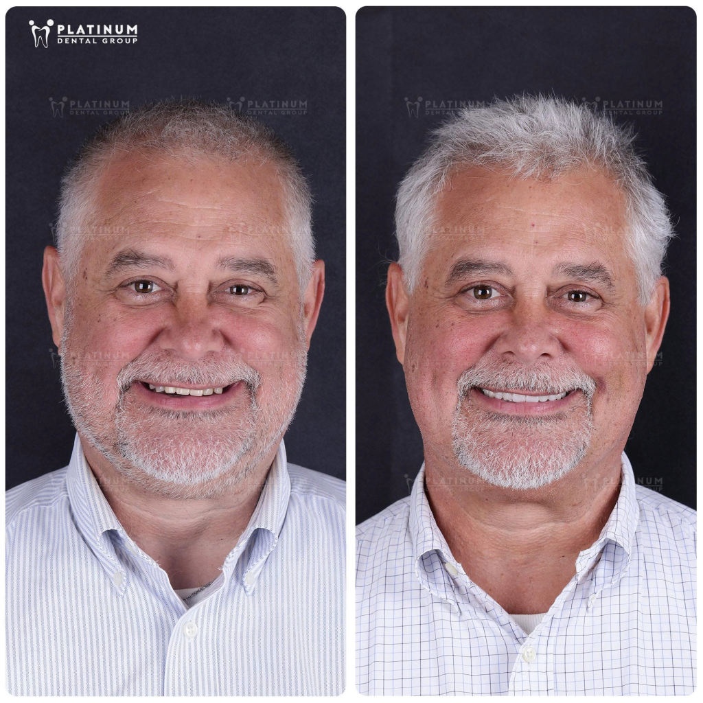 Việc chăm sóc răng miệng đúng cách sau khi cắm Implant giúp kiểm soát tốt các phản ứng thường gặp sau phẫu thuật