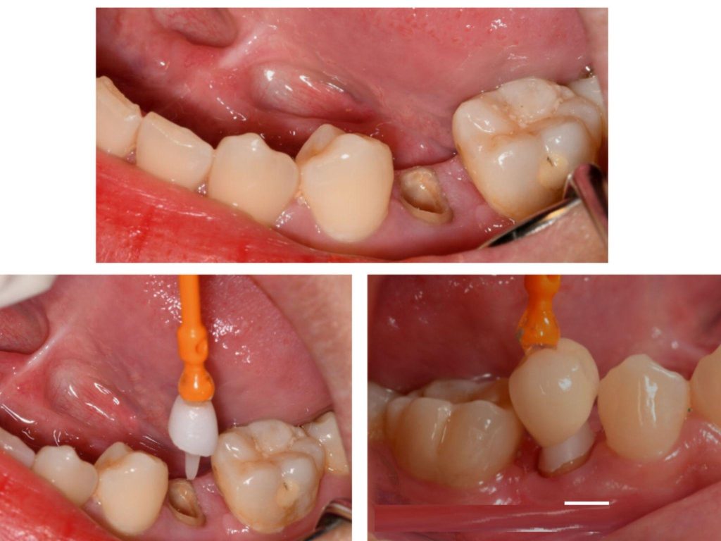 Core build up dental using Composite
