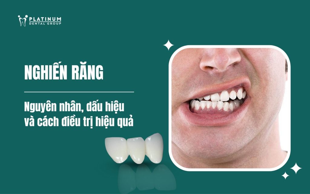 Nghiến răng: Nguyên nhân, dấu hiệu và cách điều trị hiệu quả 1 nghiến răng