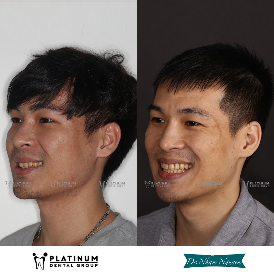 Nghiến răng: Nguyên nhân, dấu hiệu và cách điều trị hiệu quả 6 Nghiến răng kéo dài có thể gây mất thẩm mỹ khuôn mặt