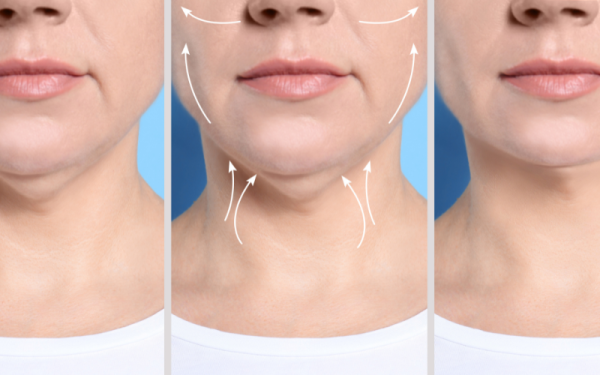Phẫu thuật thẩm mỹ hàm – mặt giúp gọt hàm, độn cằm và hạ gò má, mang lại gương mặt hài hòa và tự nhiên