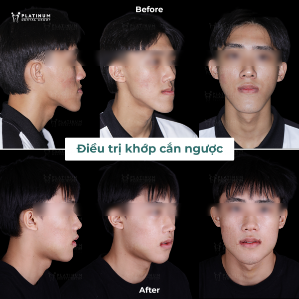 Phẫu thuật hàm điều trị khớp cắn ngược