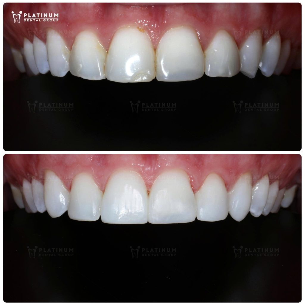 Porcelain bonding is a cosmetic dental method that helps restore chipped teeth
