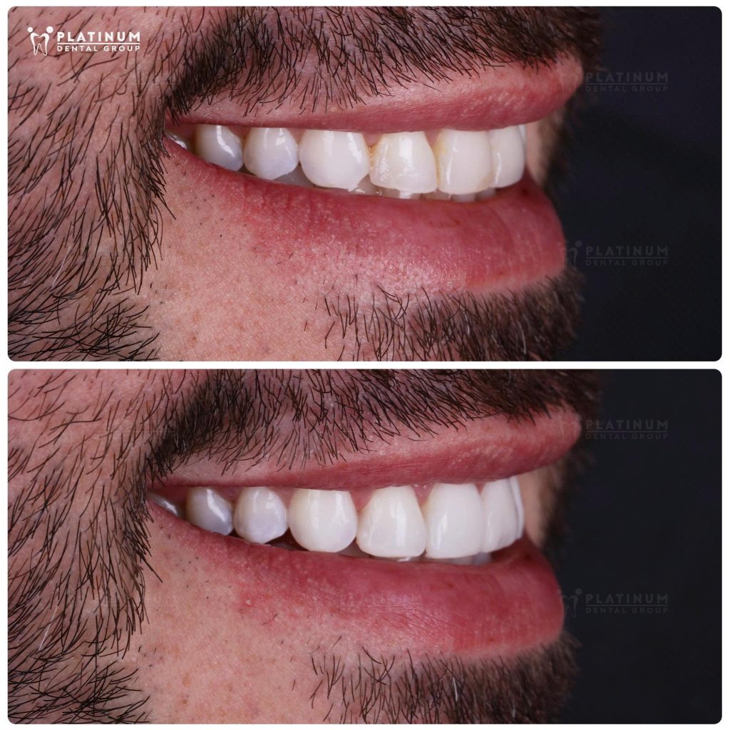 cosmetic porcelain bonding services