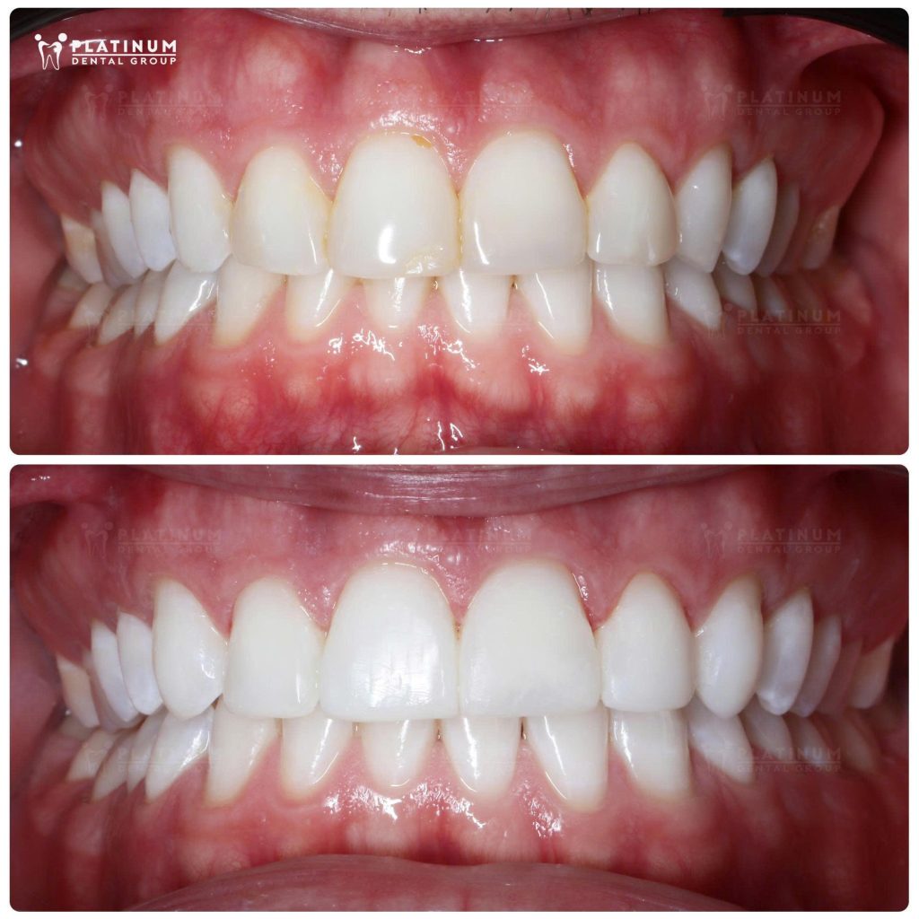 real results of cosmetic porcelain bonding services