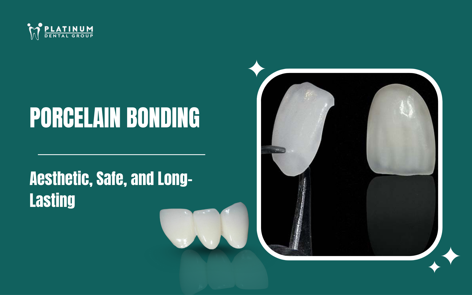 porcelain bonding