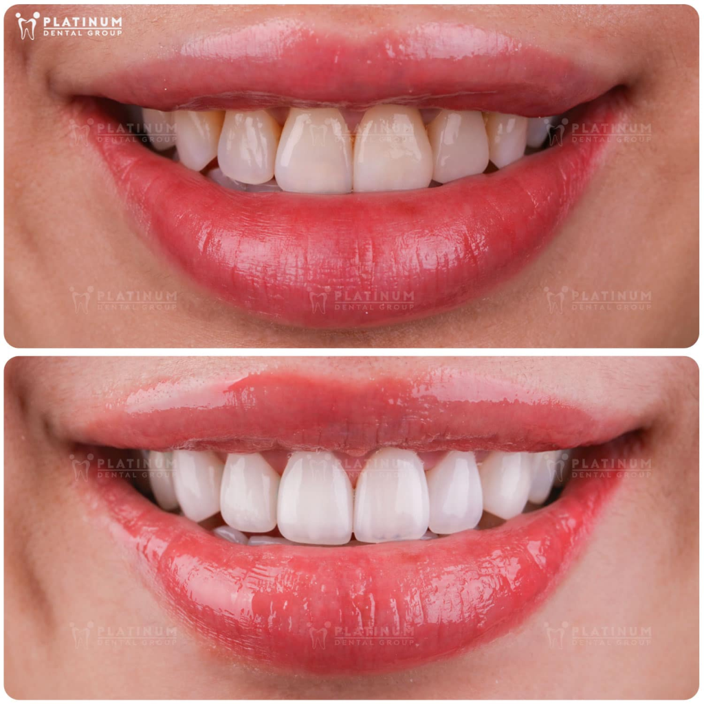 Các dấu hiệu nhận biết răng sứ đang bị ố vàng