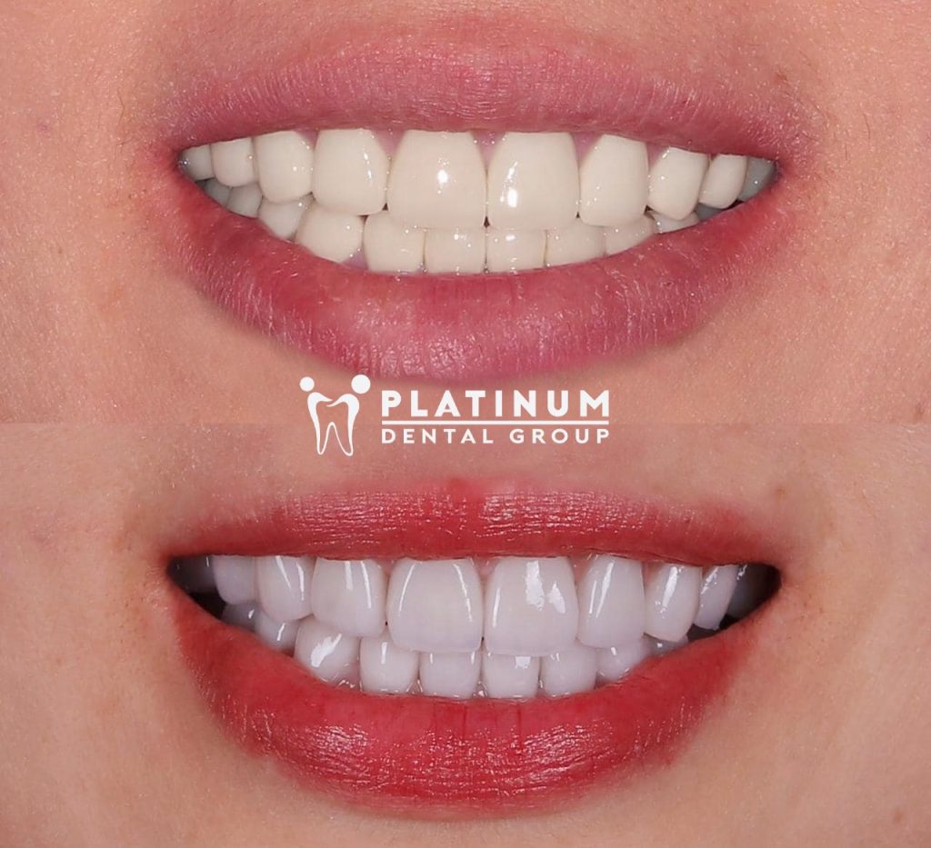 Trong trường hợp răng sứ đã xuống màu từ bên trong thay mão sứ mới là giải pháp cần thiết