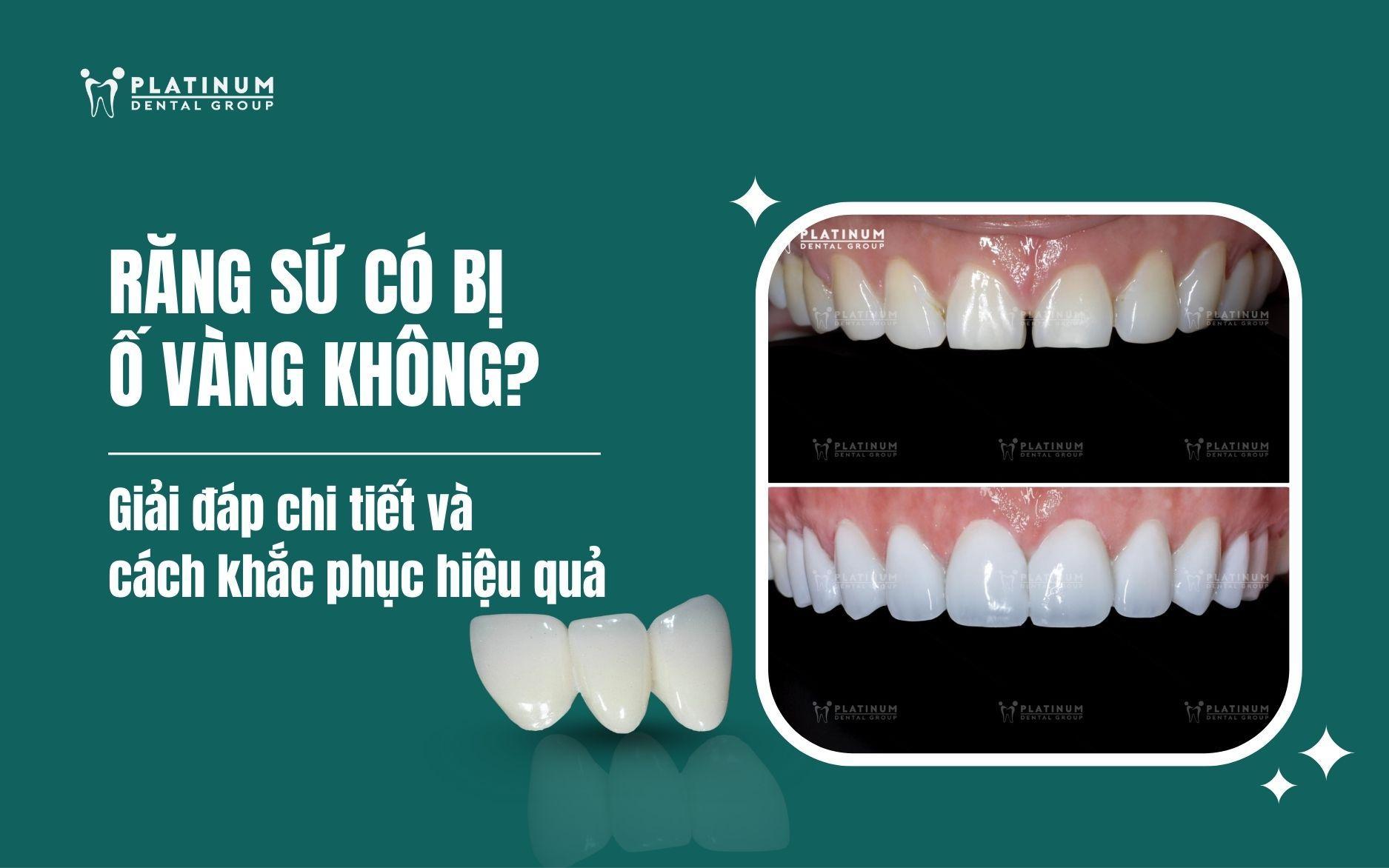 răng sứ có bị ố vàng không