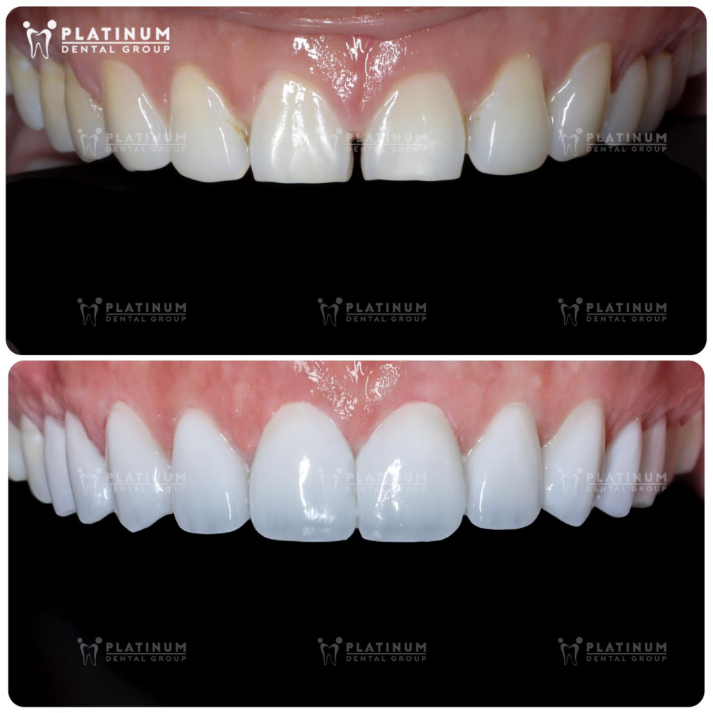 Răng sứ có bị ố vàng không?