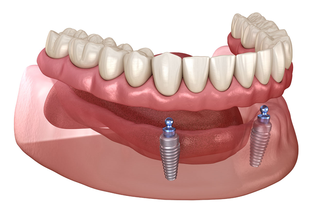 Removable Dentures: Advantages, Types, and Key Considerations 5 Implant-supported overdentures combine the stability of dental implants with the convenience of a removable denture for a secure, natural-feeling fit