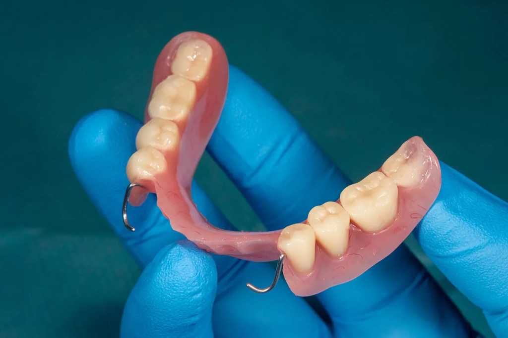 Removable Dentures: Advantages, Types, and Key Considerations 1 Removable dentures are custom-designed to restore your smile's natural appearance and function, offering a convenient and effective solution for missing teeth