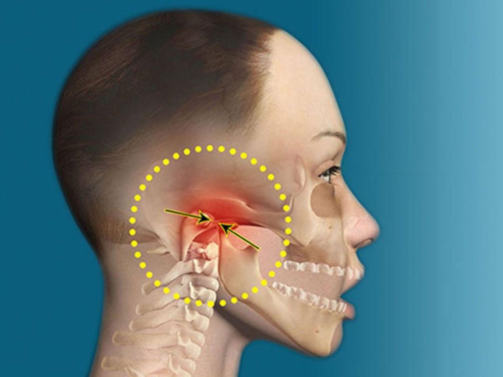 Rối loạn khớp thái dương hàm: Triệu chứng, nguyên nhân và cách điều trị, khắc phục 2 Rối loạn khớp thái dương hàm là gì?