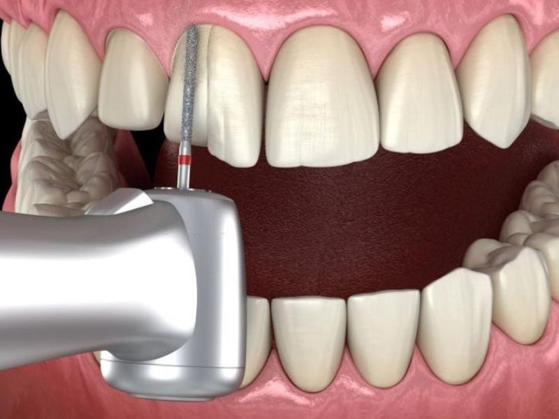 Excessive shaving wears down enamel, making teeth weak and prone to decay