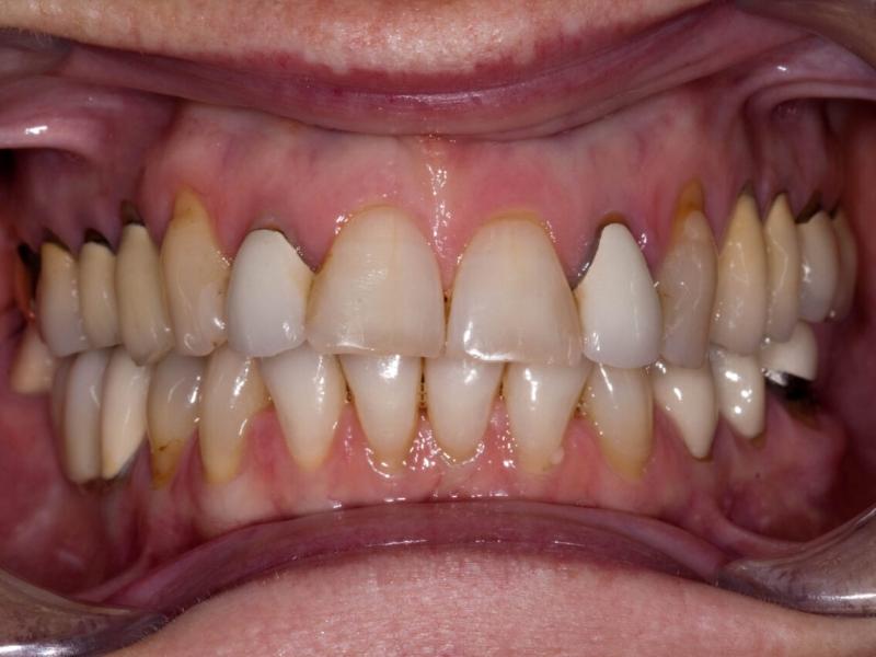 Incorrect technique when having a shaved tooth for crown or using metal porcelain can easily cause dark gum lines and loss of aesthetics