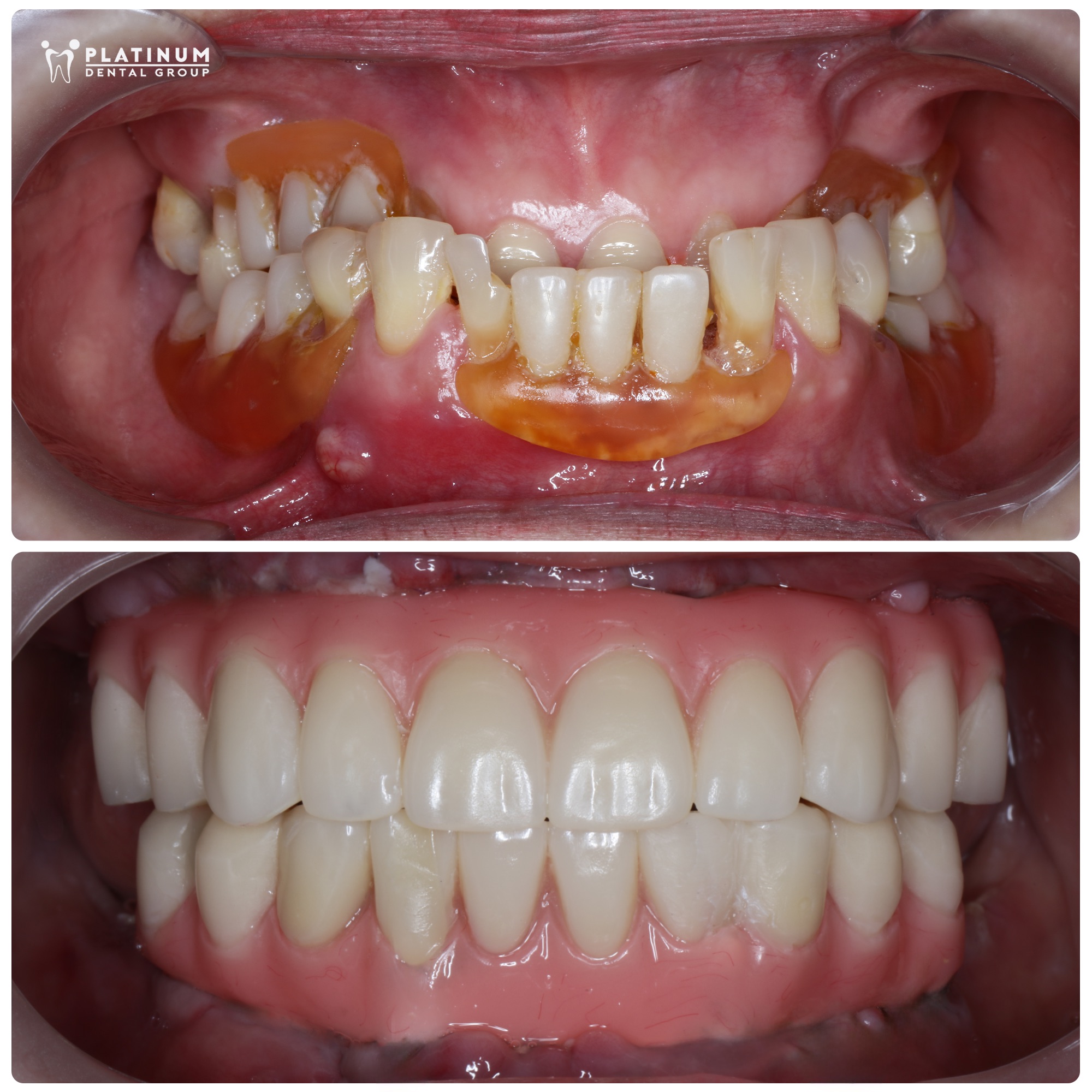 Thiết lập một khớp cắn mới, có đầy đủ răng giúp cô Thoa ăn nhai được bình thường như bao người