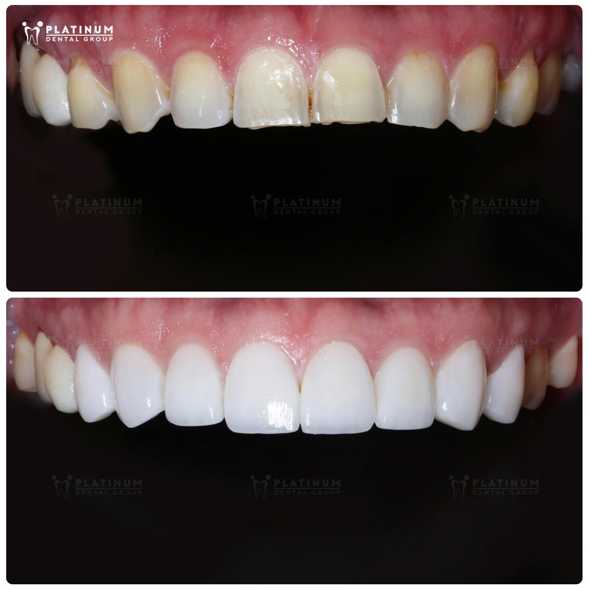 Hàm trên với khá nhiều diện mòn ngắn ở vùng răng cửa