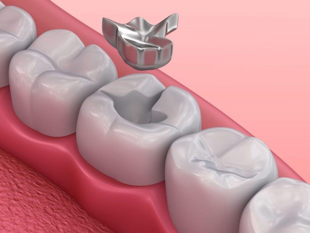 Amalgam là vật liệu kim loại trộn, có độ cứng và độ bền cao