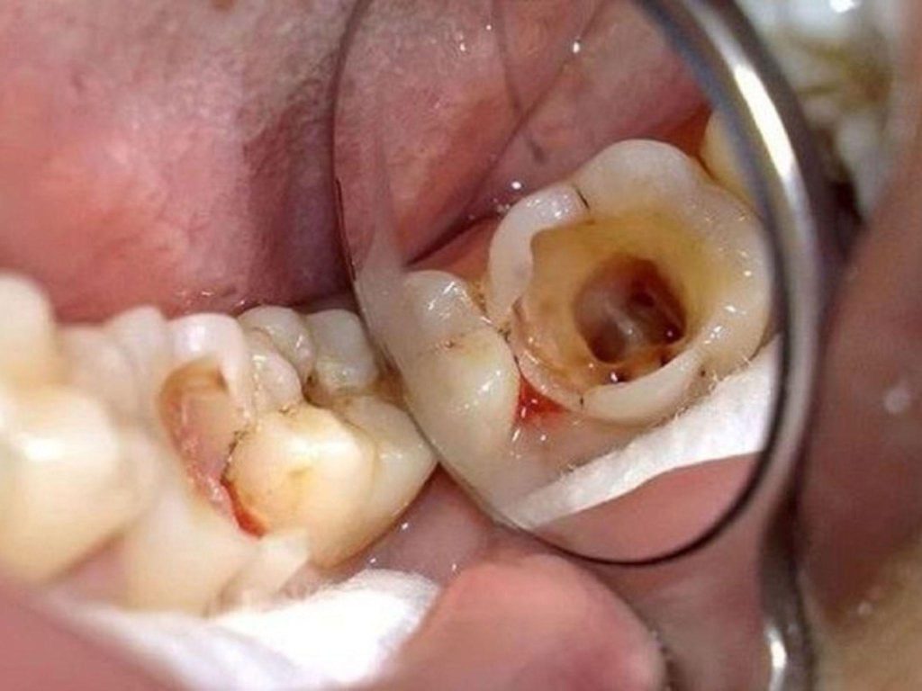 Khi nào cần thực hiện tái tạo cùi răng?