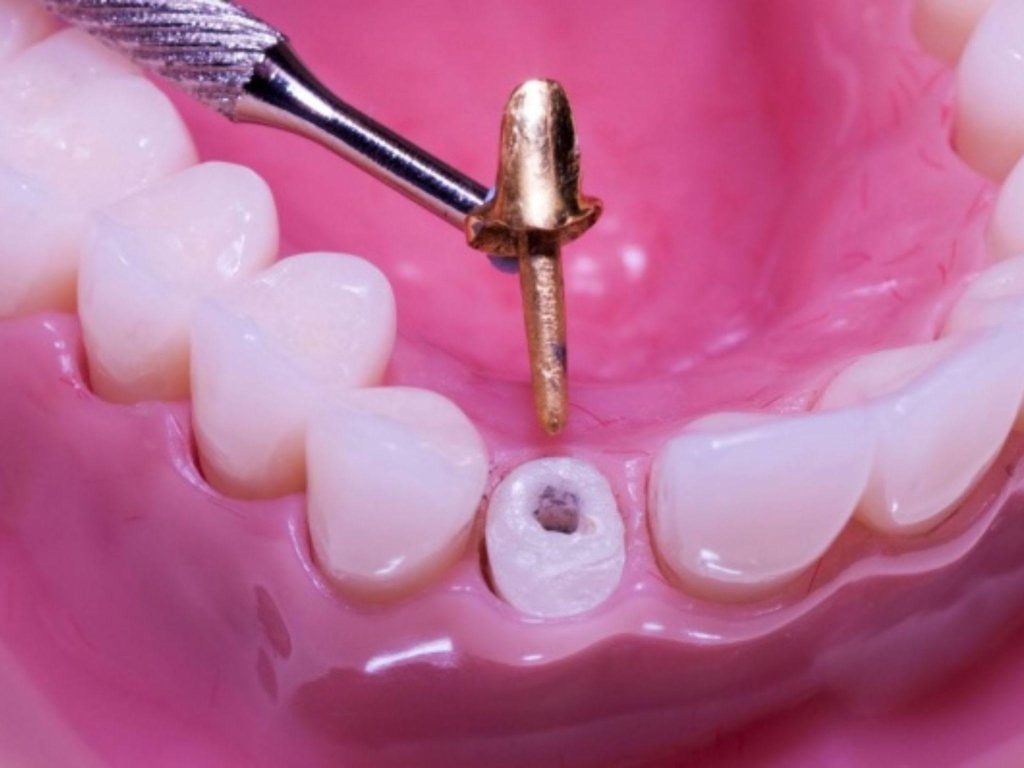 Tái tạo cùi răng là gì?